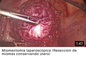 Miomectomía laparoscópica (Resección de miomas conservando útero)