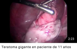 Teratoma gigante en paciente de 11 años