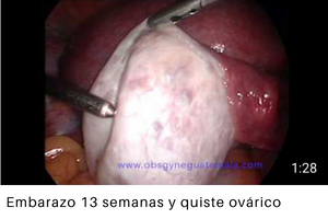 Embarazo 13 semanas y quiste ovárico